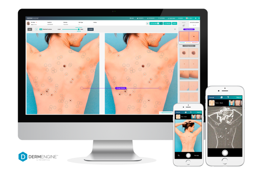 Total Body Mole Mapping With Dermengine 9178